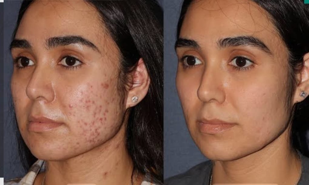 Acne Removal