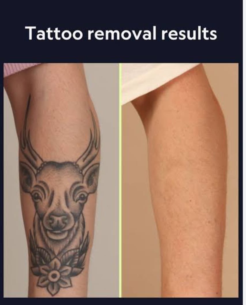 Tattoo Removal