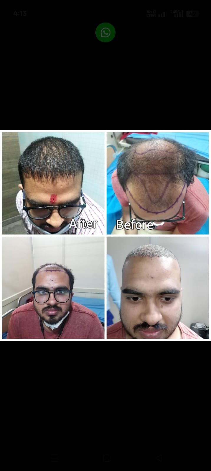 Hair Transplant