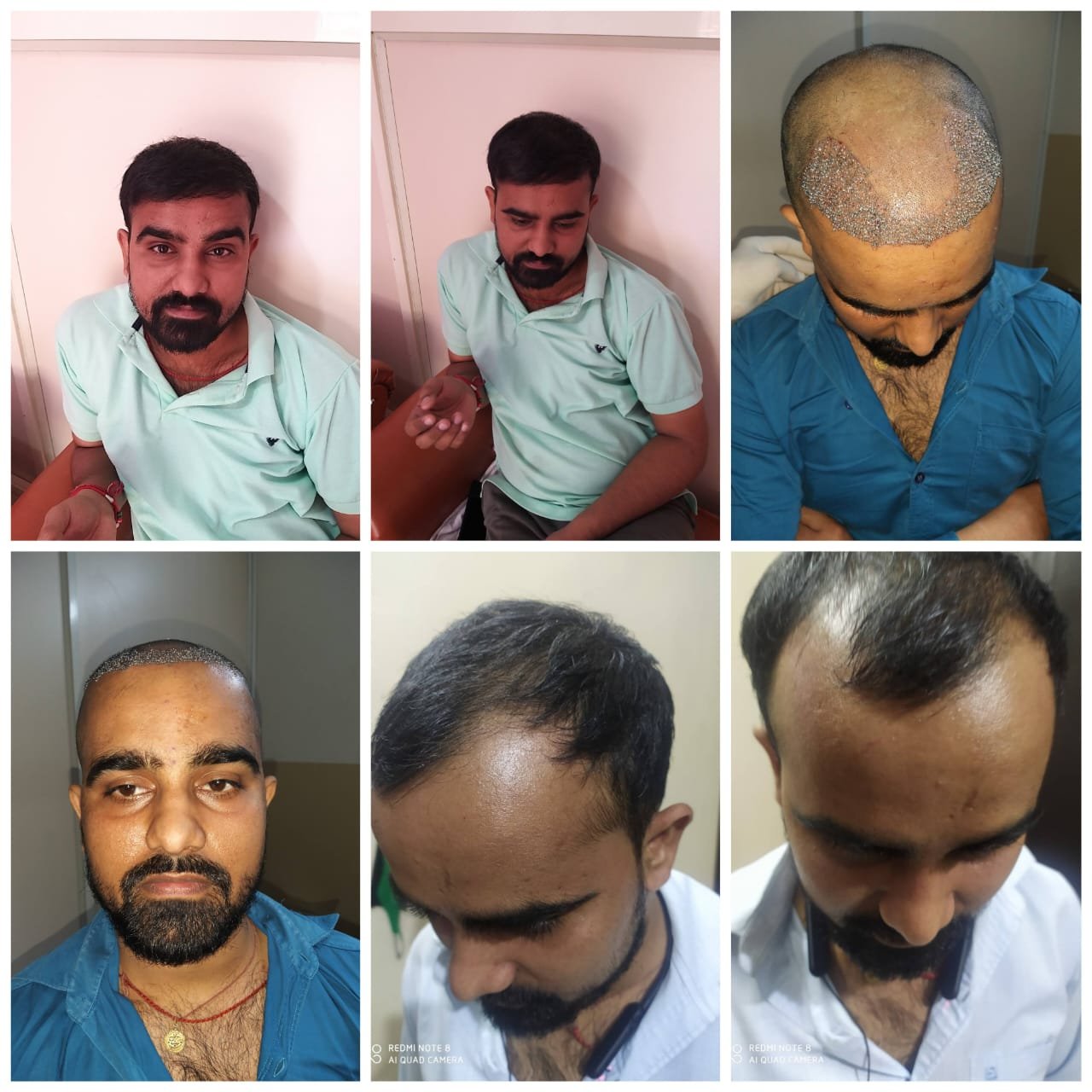 Hair Transplant