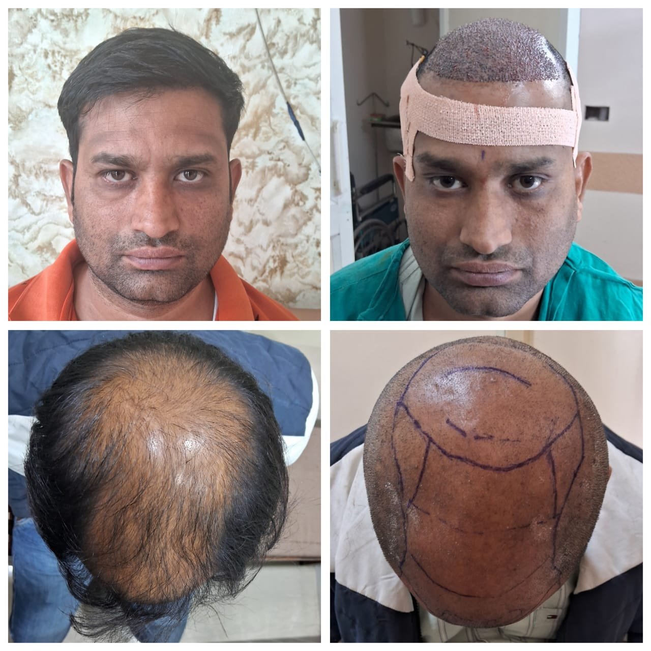 Hair Transplant